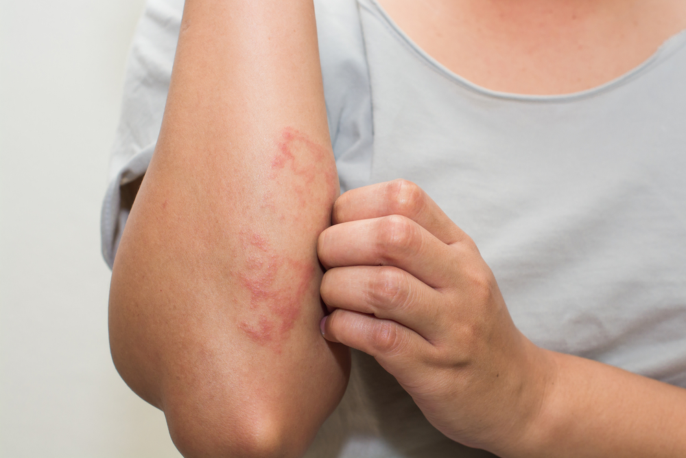 Alergije i dermatitisi