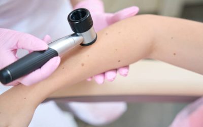 Dermatoskopija – Vaša prva linija obrane protiv kožnih oboljenja
