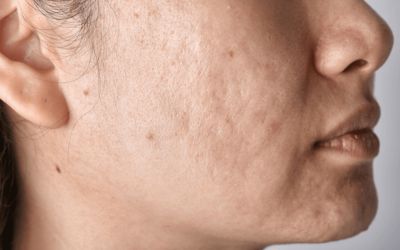 Revolucija u njezi kože: Otkrijte tajne učinkovitog uklanjanja ožiljaka od akni