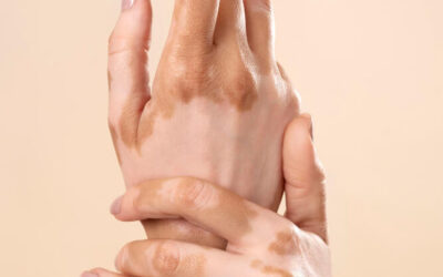 Vitiligo: Razumijevanje, suočavanje i nade u liječenje