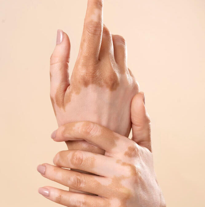 Vitiligo: Razumijevanje, suočavanje i nade u liječenje