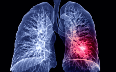 Embolija pluća: Tihi ubojica koji se može prepoznati na vrijeme – evo kako