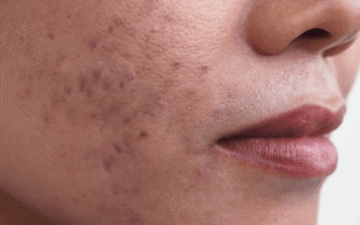 Hiperpigmentacijske mrlje: što ih uzrokuje i kako ih izbrisati s kože