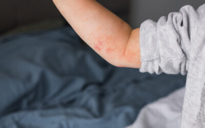 Atopijski dermatitis kod djece: kako prepoznati, liječiti i olakšati svakodnevicu