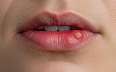 Koliko dugo je herpes zarazan