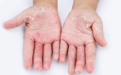Kontaktni dermatitis: kako prepoznati i uspješno liječiti iritaciju kože
