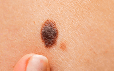 Melanocitni madež: kada bezazleni madež postaje upozorenje