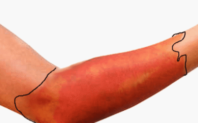 Crveni vjetar – simptomi, najčešća mjesta pojave i je li zarazna bolest