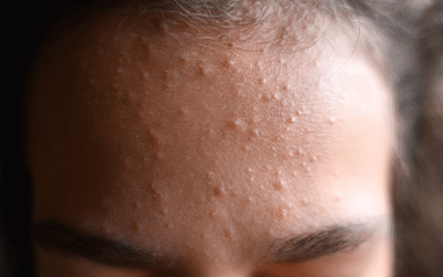 Komedoni na licu – uzroci, rješenja i kako ih se trajno riješiti