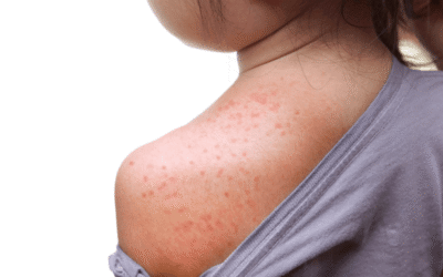 Osip kod djece – kako prepoznati uzrok i kada se javiti liječniku